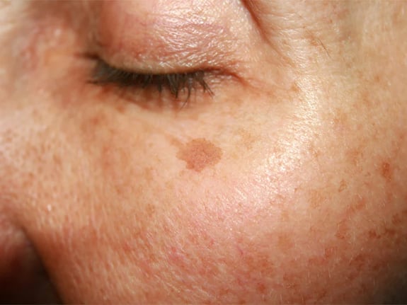Age Spots
