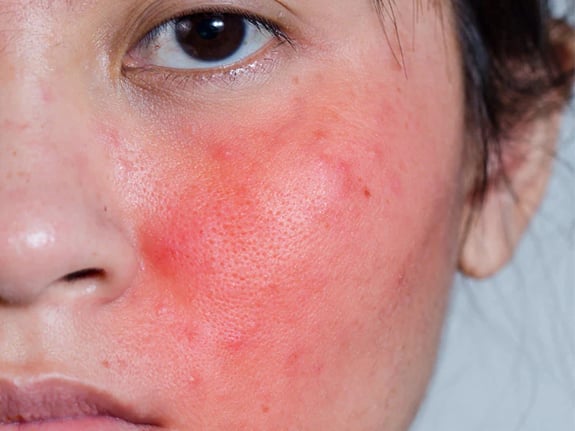 Blemishes