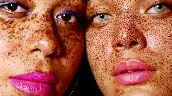 Uneven Skin Tone